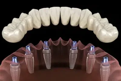 all-on-4-implant-plano-tx