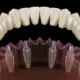 all-on-4-implant-plano-tx