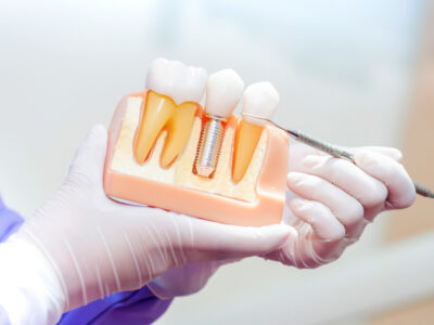 dental implants