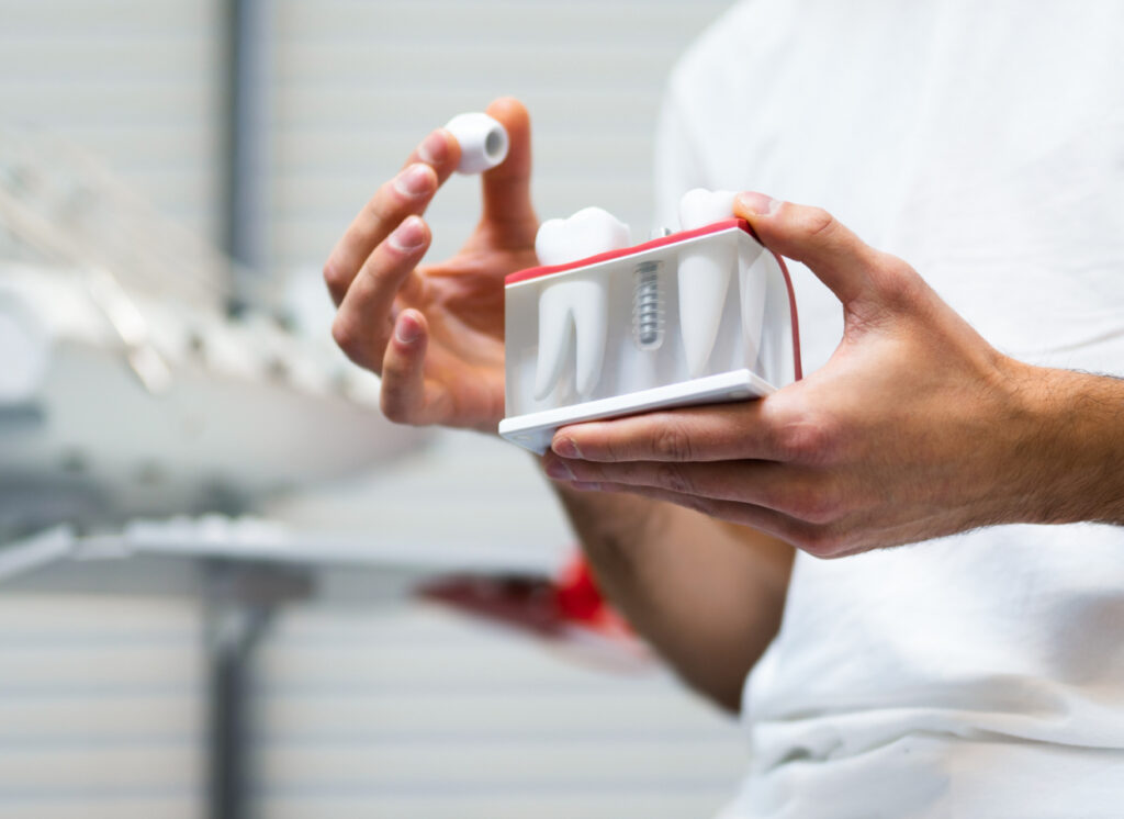 dental implants and