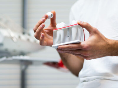 dental implants and bone structure