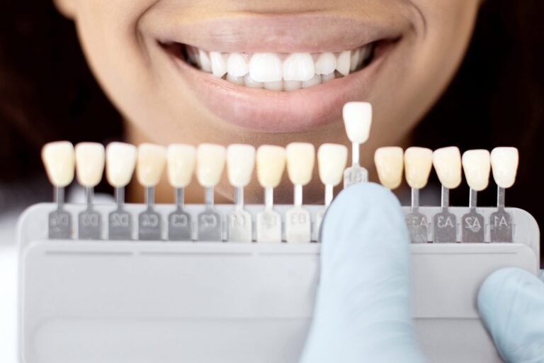 Gloved hand selecting a veneer shade tab beside a patient's natural teeth