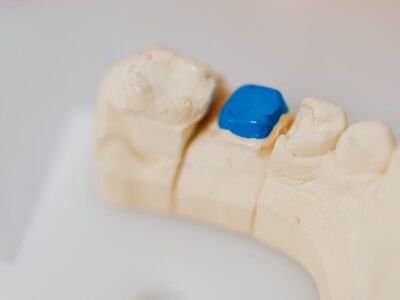 Stone dental model of back teeth with a blue filling placed in one tooth