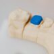 Stone dental model of back teeth with a blue filling placed in one tooth