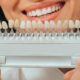 Porcelain veneer shade guide held in front of a smile to compare tooth colors